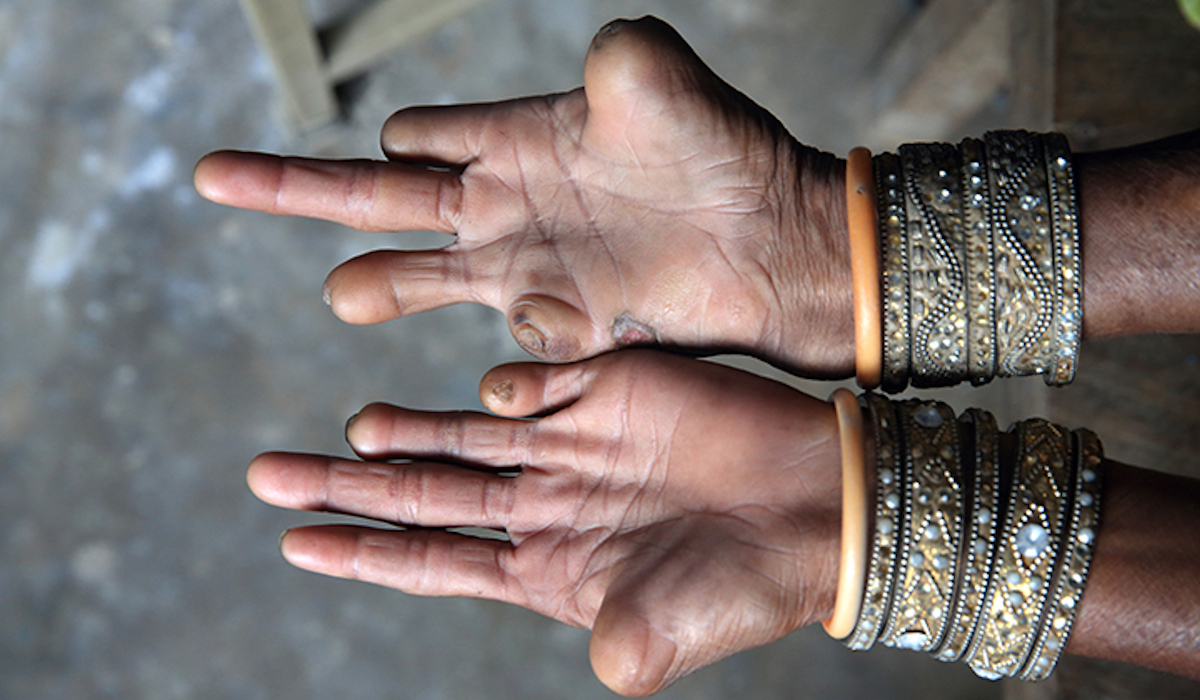 How a Swiss doctor and a Swiss volunteer changed my thoughts about leprosy patients